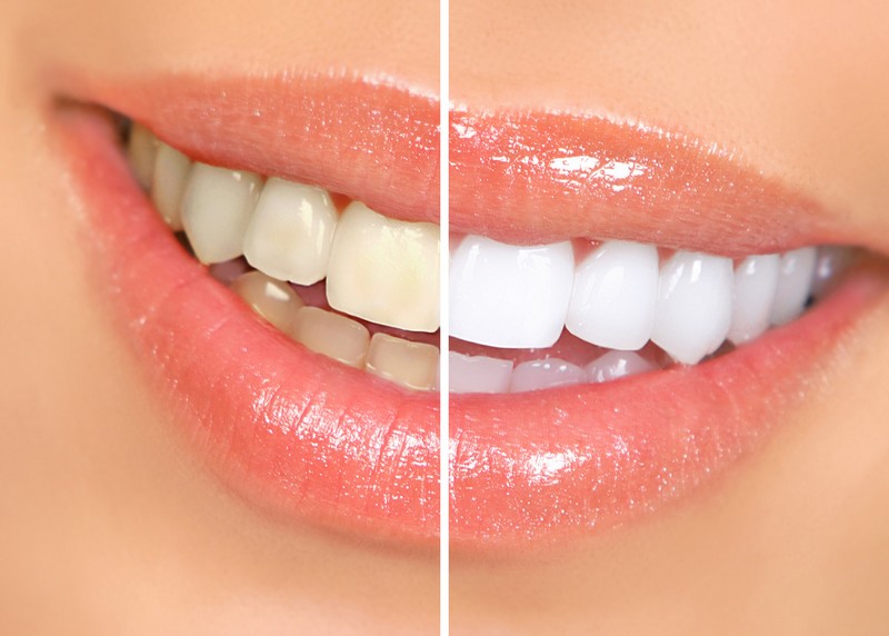 Teeth Whitening  Yorktown, VA , 